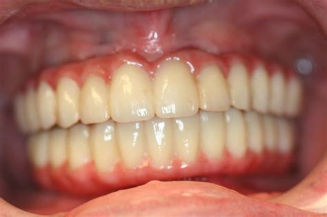 dental implants greensburg pa|Oral Surgeon .